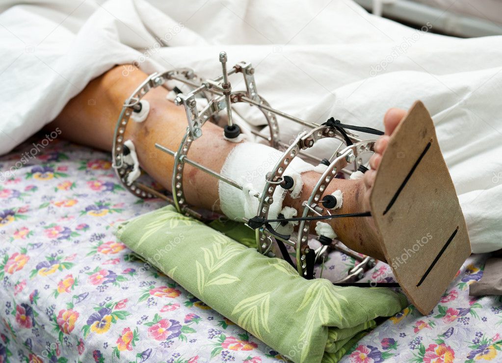 Leg in Ilizarov's external fixator, Ilizarov's apparatus — Stock Photo