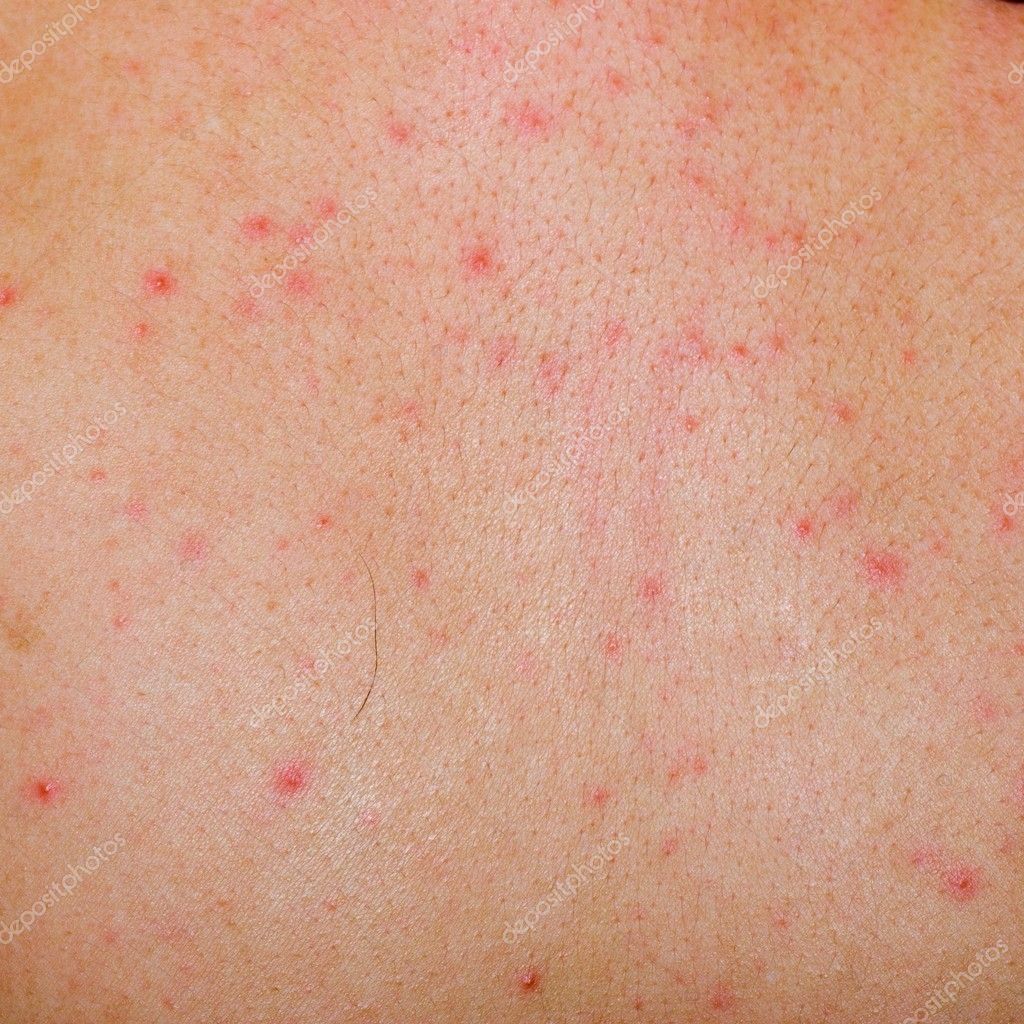 Allergy Rash