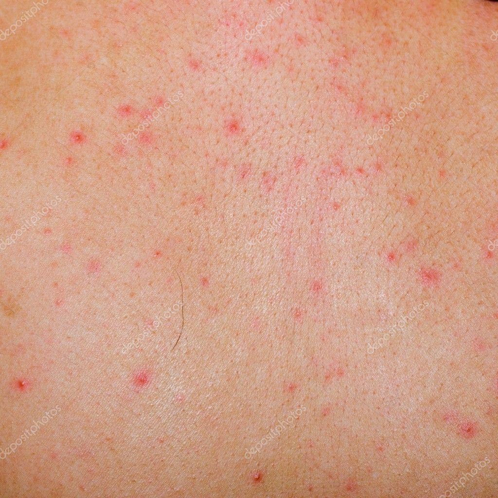 Allergic Rash Dermatitis Skin — Stock Photo © Panxunbin 6926399