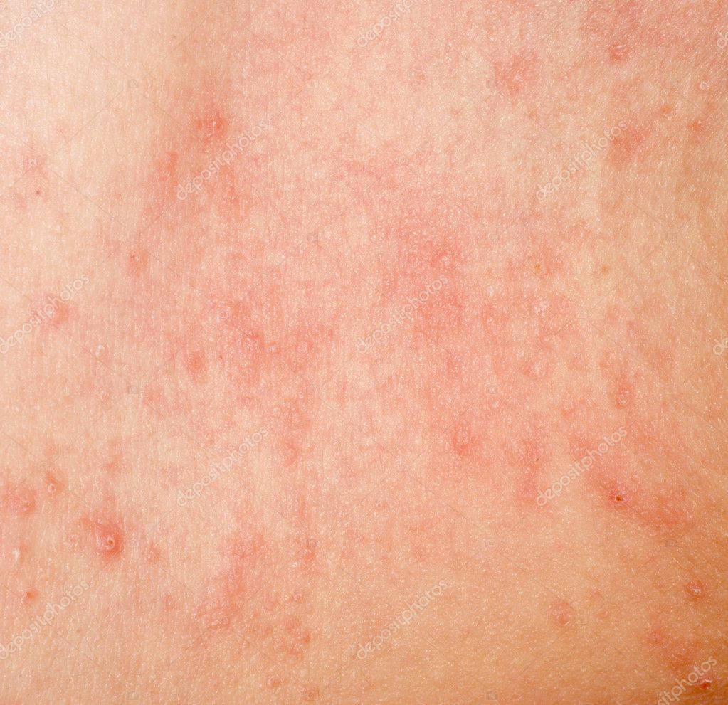 Allergy Rash