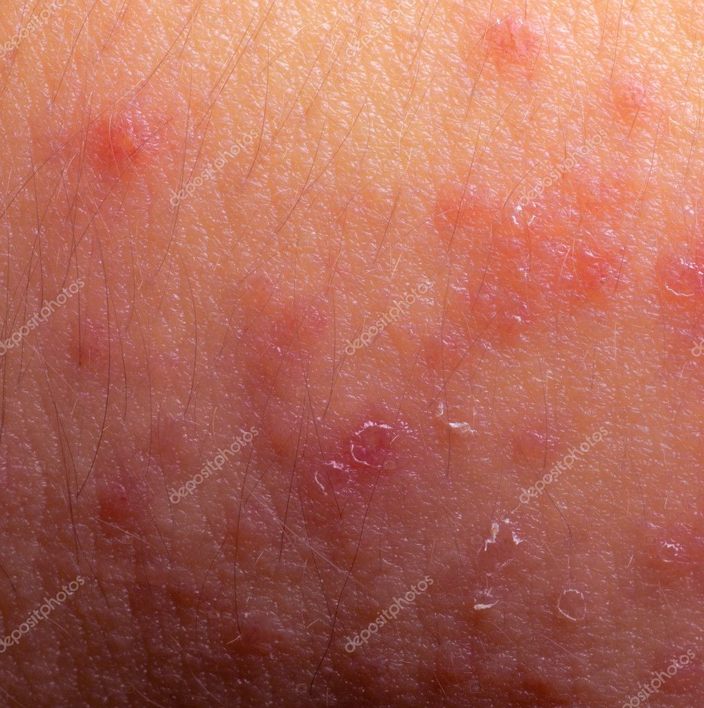 eczema bumps