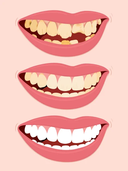 caries stages