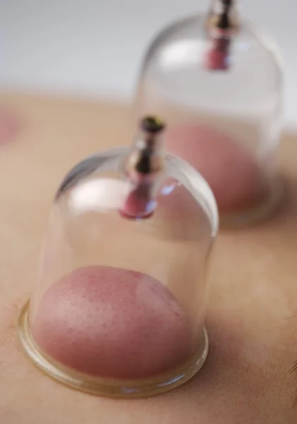 Cupping therapy in traditional chinese medicine