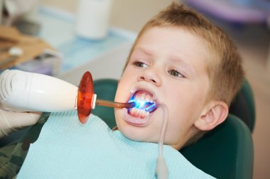 Dental filing of child tooth by ultraviolet light clipart