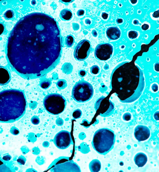 Cellules cancéreuses — Photo