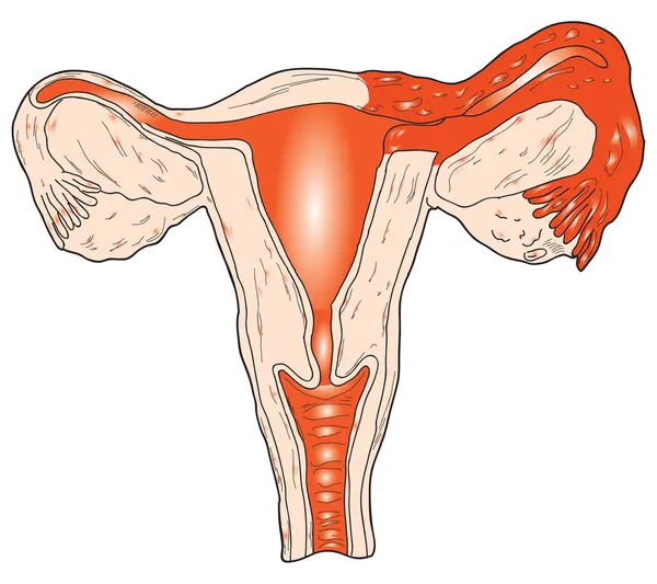 Inflammation of the uterus — Stock Vector