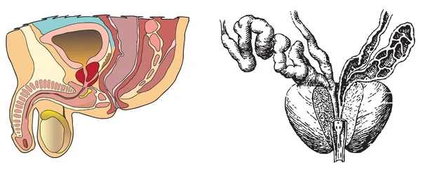 La prostatitis es una ilustración — Vector de stock