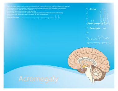 Acromegaly clipart