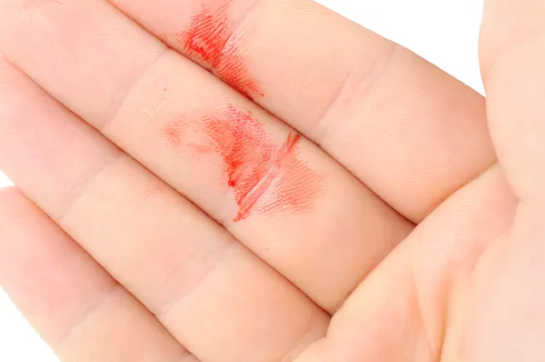 Blut an der Hand — Stockfoto