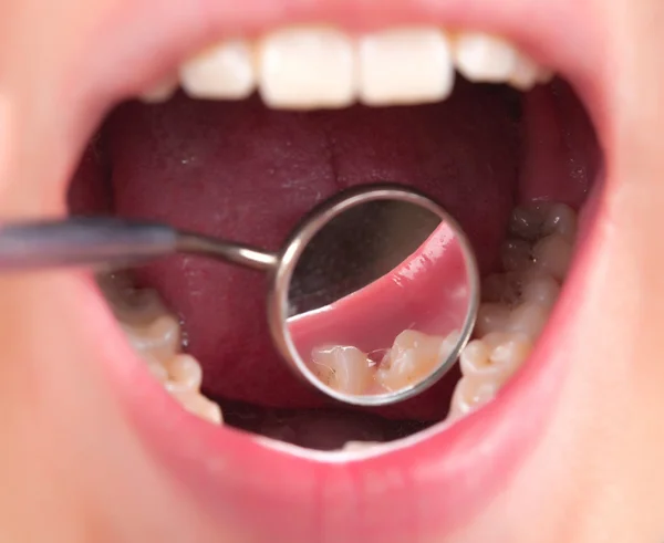 Zahnbehandlung beim Zahnarzt — Stockfoto