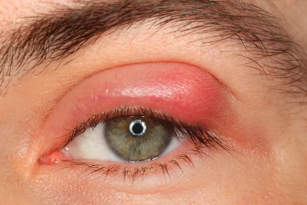 Болезнь глаза человека с хлевом и гной глядя в камеру — стоковое фото