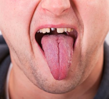 kırık diş ve dil ile yüz