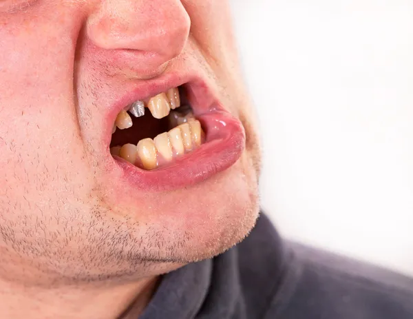 Tvář mladého muže s zlomený zub — Stock fotografie