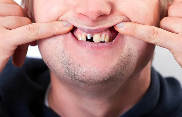 Cara de hombre joven con diente roto — Foto de Stock
