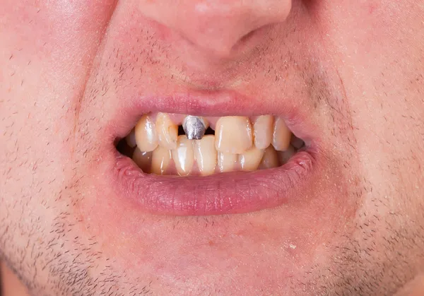 Cara de hombre joven con pasador dental — Foto de Stock