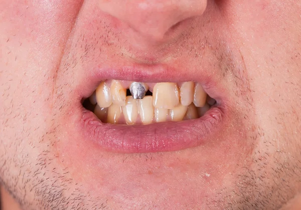 stock image Young man face with tooth pin