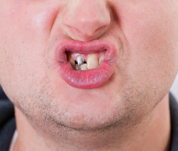 Jovem cara de homem com pino de dente — Fotografia de Stock