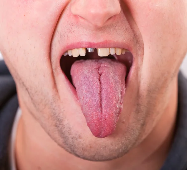 stock image Face with broken tooth and tongue