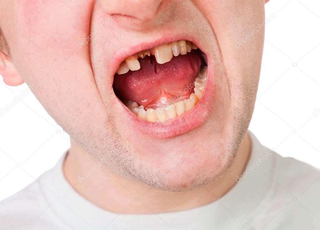 Young man face with broken tooth