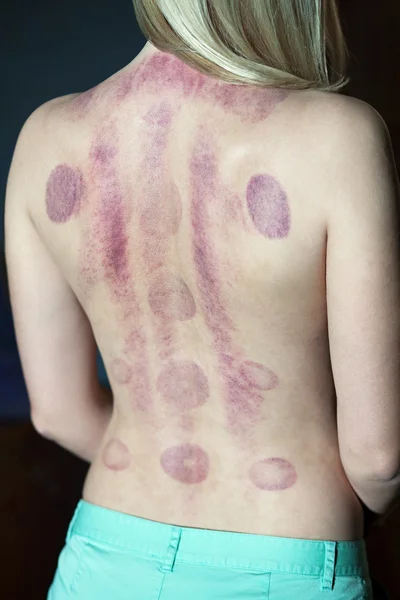 Spår efter kinesiska massage vakuum banker — Stockfoto