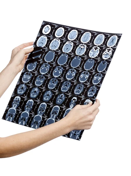 Руки доктора с МРТ головы — стоковое фото