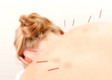 Acupuncture Patient Treatment in Back clipart