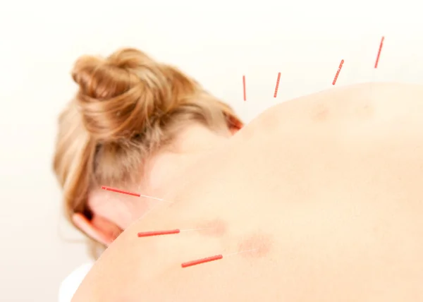 Tratamento do paciente da acupuntura nas costas — Fotografia de Stock