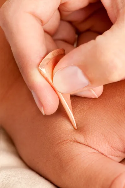 米山鍼治療ツールのマクロの詳細 — ストック写真