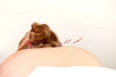 Acupuncture Needles on Back clipart