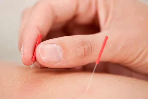 Akupunktura makro — Zdjęcie stockowe