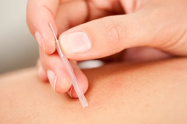 Akupunktur nål med insättningspunkten rör — Stockfoto