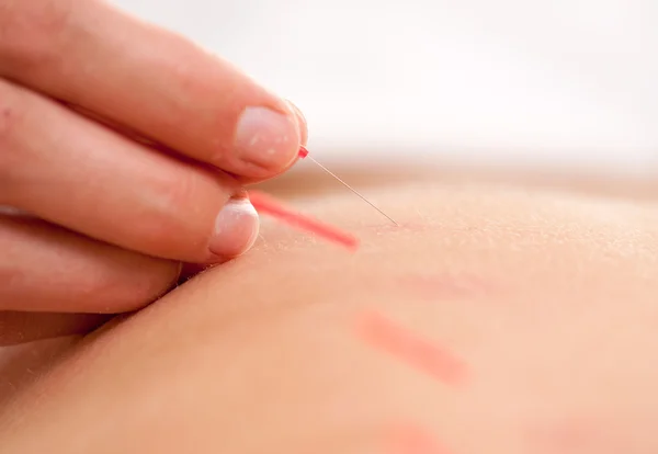 Akupunktur stimulering makro — Stockfoto