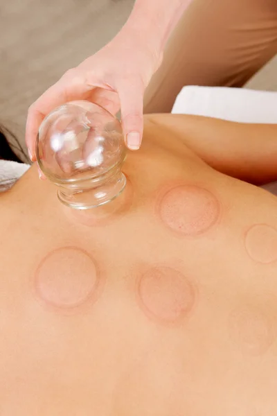 Red Fire Cupping Marks — Stock Photo, Image
