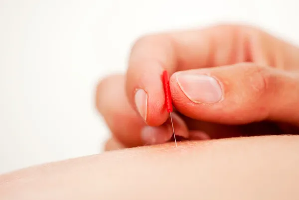 Agulha de acupuntura sendo estimulada — Fotografia de Stock