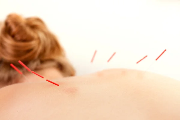 Akupunktura na powrót shu punktów — Zdjęcie stockowe