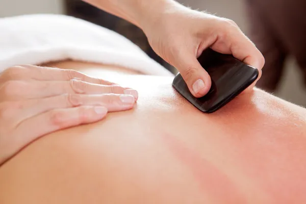 Leczenie akupunktura Gua-sha na plecach — Zdjęcie stockowe