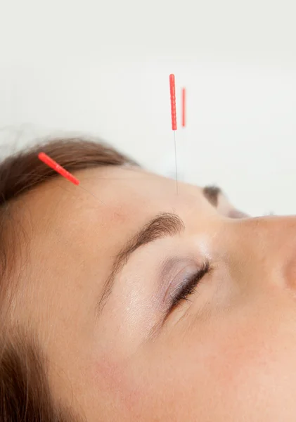 Gezicht acupunctuur — Stockfoto