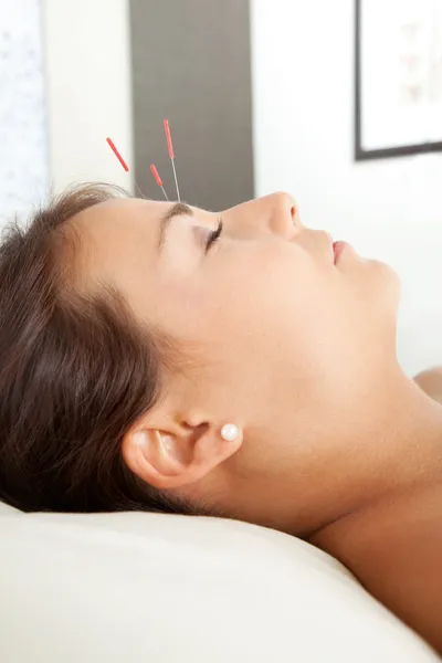 Gezicht acupunctuur — Stockfoto