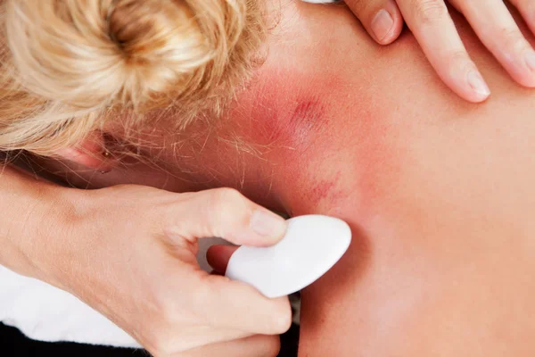 Roodheid op de nek na gua sha acupunctuur — Stockfoto