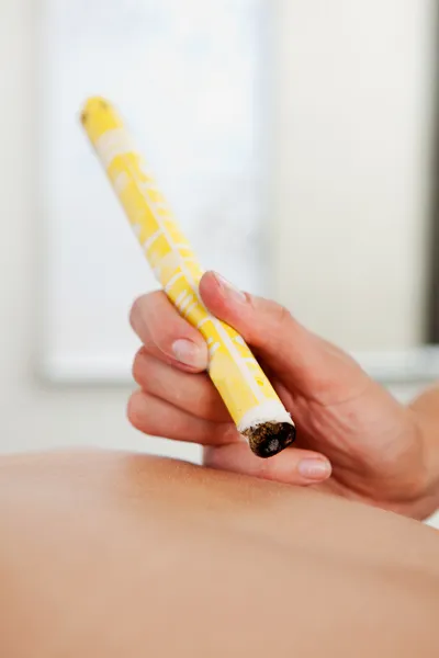 Moxibustion Acupuncture Technique — Stock Photo, Image