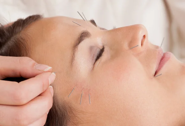 Détail du traitement d'acupuncture faciale — Photo