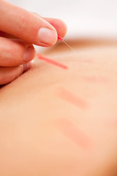Qi - Acupuncture Neddle Rotation and Stimulation — Stock Photo, Image