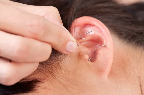 Dettaglio agopuntura dell'orecchio — Foto Stock