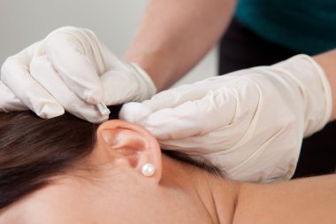 Auricular Acupuncture Treatment clipart