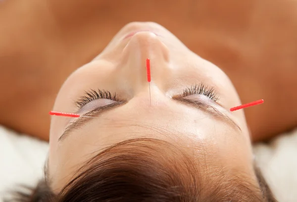 Tratamento anti-envelhecimento da acupuntura — Fotografia de Stock