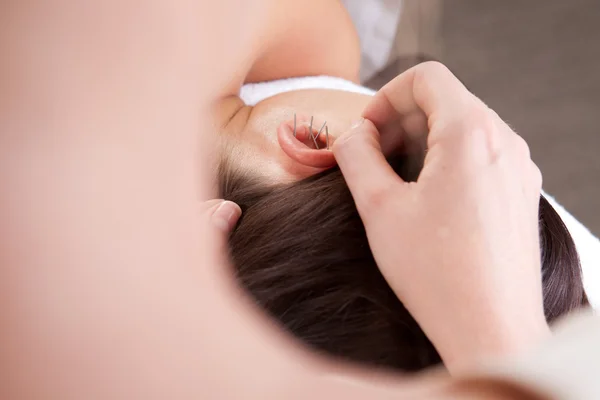 Kulak akupunktur tedavisi — Stok fotoğraf