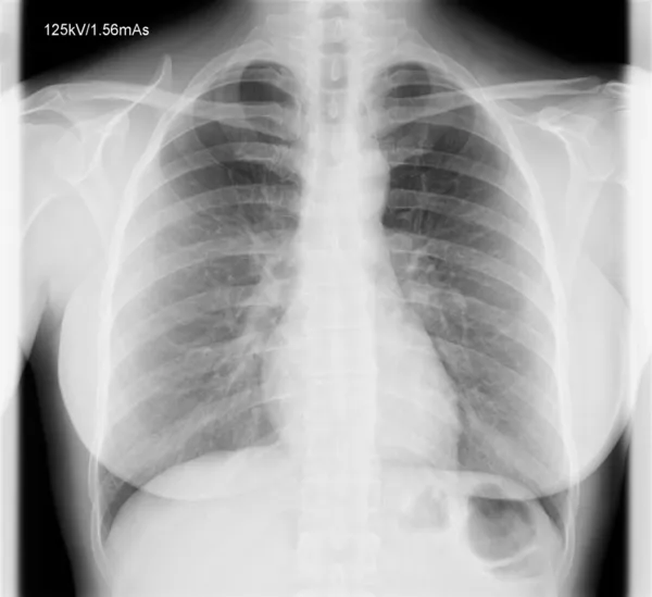 人类胸部的X射线图像 — 图库照片