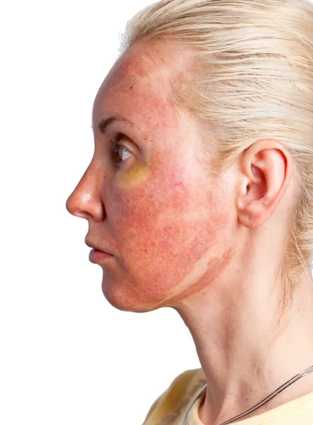 Kosmetologi. hudens tillstånd efter kemisk peeling tca. — Stockfoto