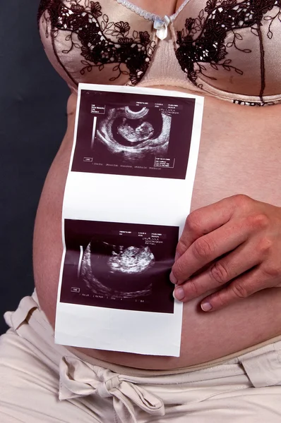 超声在妊娠期间 — 图库照片