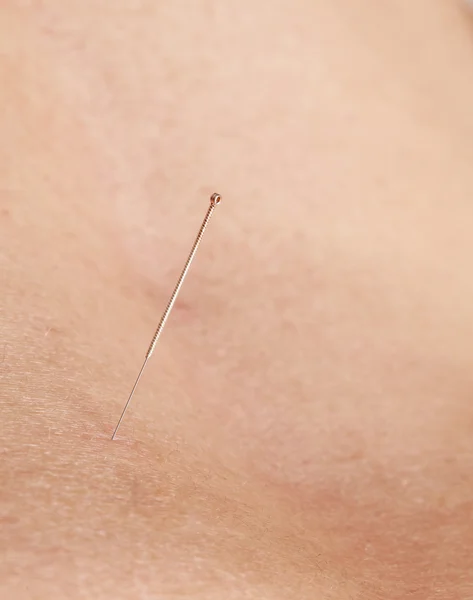 Stock image Acupuncture needle